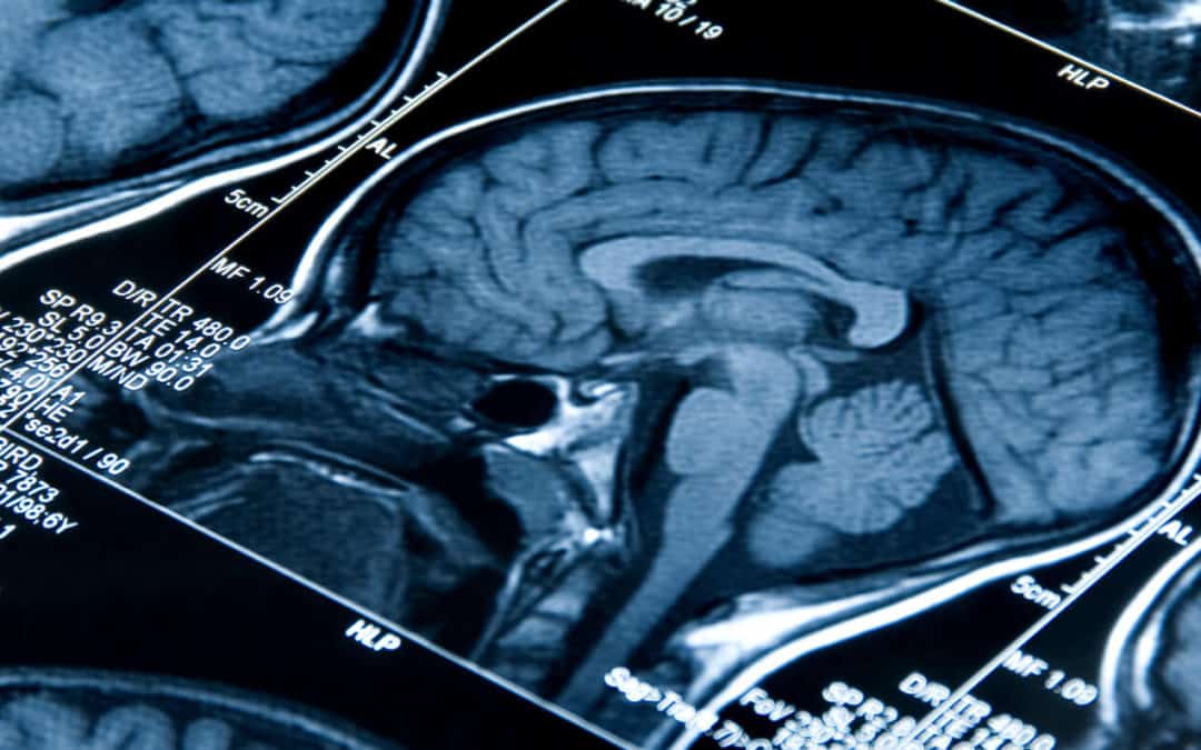 Brain Injury Causes