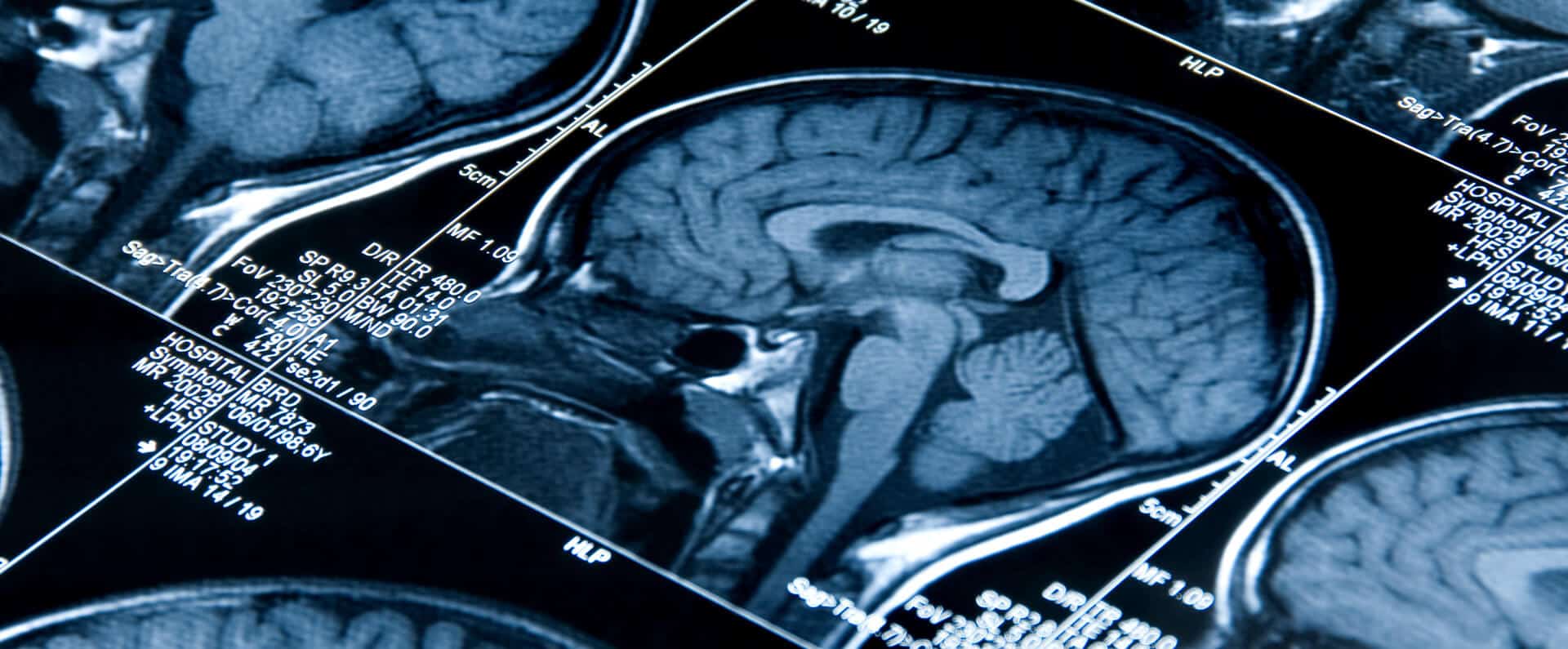 Washington DC Concussion Lawyer | CTE & TBI Injury Attorneys