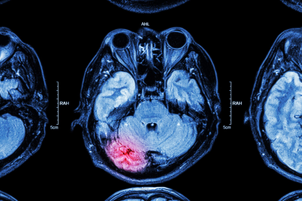 TBI treatment brain scan of a patient who also sustained blunt pelvic trauma